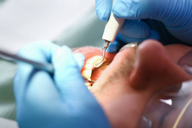 Best Emergency Dentist for Lost Fillings or Crowns in Newark, OH